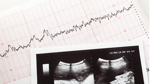 Hearing the heartbeat