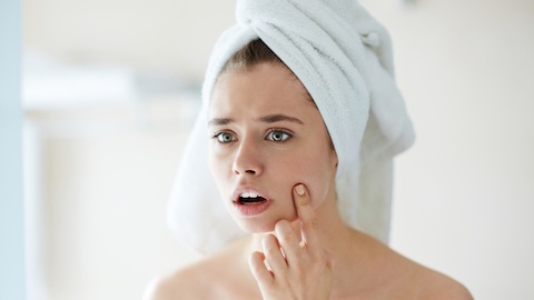 Acne during pregnancy